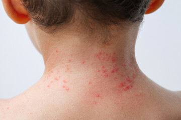 Red rashes from the Coxsackie virus on a child back on white background. Chickenpox allergy...