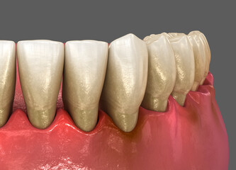 Gum recession, inflammation of the gums. Dental 3D illustration