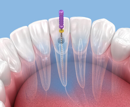 Endodontic root canal treatment process. Medically accurate tooth 3D illustration.