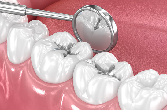 Amalgam tooth restoration. Dental 3D illustration