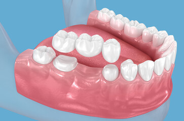 Dental bridge based on 2 teeth. Dental 3D illustration