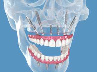 Maxillary prosthesis supported by zygomatic implants. 3D illustration