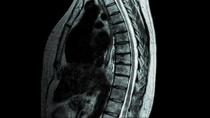 This MRI scan of the thoracic spine showcases the vertebrae and surrounding tissues. The image provides a detailed view of the spinal column and its structures - Powered by Adobe
