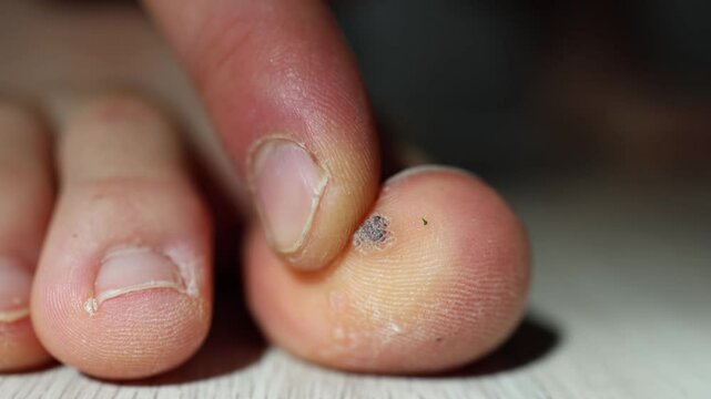 Closeup of a human toe with a dark scab and dry peeling skin under strong light showing detailed skin texture and minor injury during the healing process