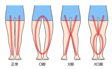 正常な脚、O脚、X脚、XO脚、女性の下肢