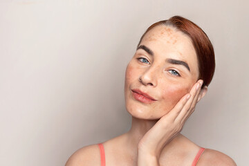 Caucasian woman face with pigmentation, melasma, freckles, age spots photo. Copy space photo