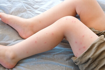 Child scratch body has sensitive itchy skin. Bodily rash. Kid allergy closeup. Little baby...