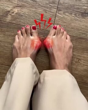 "Hallux Valgus Bunion Animation" &ndash; Targets precise medical terms. "Inflammation on Toes" &ndash; Explains the visual and condition. "Foot Pain Close-Up" &ndash; Adds searchable context for doctors, educators, and