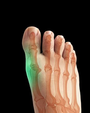 "Hallux Valgus Bunion Animation" &ndash; Targets precise medical terms. "Inflammation on Toes" &ndash; Explains the visual and condition. "Foot Pain Close-Up" &ndash; Adds searchable context for doctors, educators, and
