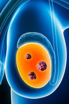 X-ray anterior or front view of human testicles or testes with cancer cells 3D rendering illustration with body contours. Organ of male reproductive system, medical, oncology, healthcare concepts.