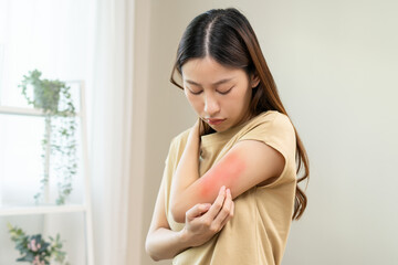 Dermatology asian young woman, girl allergy, allergic reaction from atopic, insect bites on her...