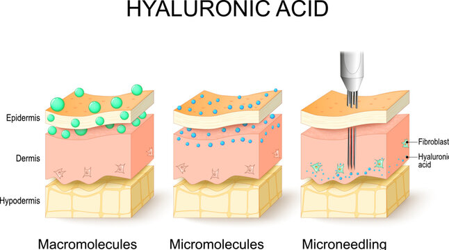 Hyaluronic acid, microneedling, micromolecules, macromolecules
