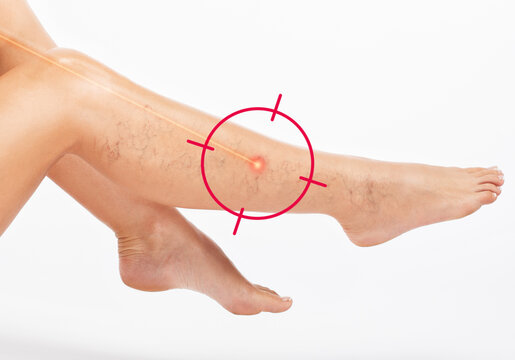 Beautiful slender woman sits on a couch in a spa salon. She shows varicose veins in the lower legs.Treatment of varicose veins and capillaries.