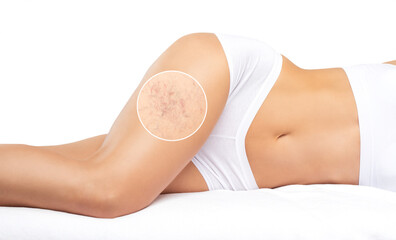 Beautiful slender woman sits on a couch in a spa salon. She shows varicose veins in the lower...