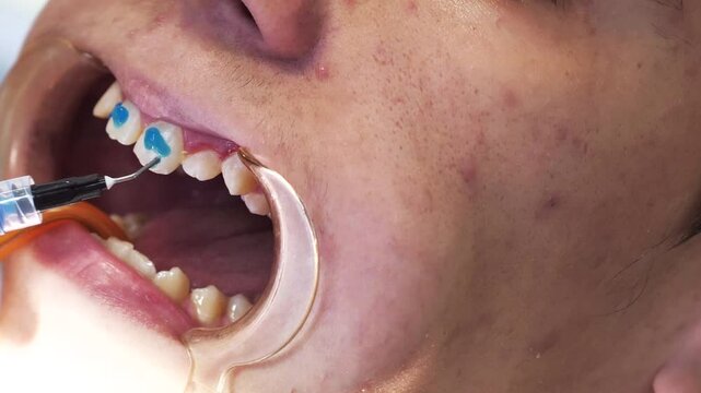 Applying etching gel to tooth enamel at the place where the braces will be fixed