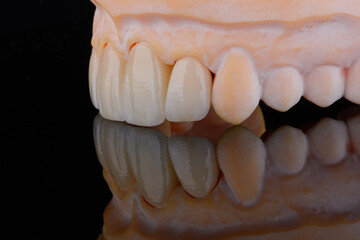 High-quality four dental crowns made of zirconium for fixation to the frontal teeth of upper jaw.