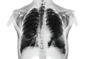 Chest X-Ray: Lung Anatomy