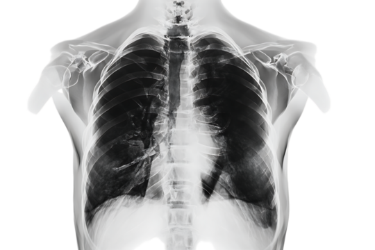 Chest X-Ray: Lung Anatomy