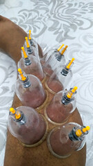 Traditional Cupping Therapy on Lower Leg – Alternative Medicine Treatment