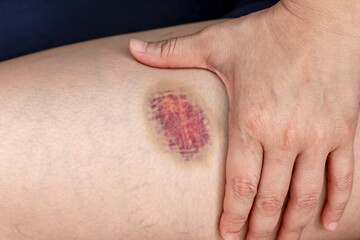 Fototapeta premium Close-up of a bruise on the wounded skin of woman leg to severe impact