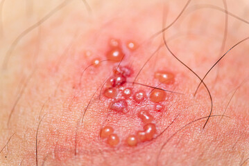 skin rash and blisters on body
(Shingles,herpes zoster)
