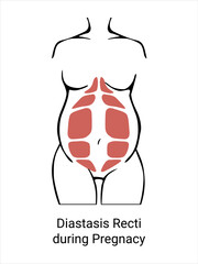Diastasis in a woman during pregnancy. The anatomy of a Woman. A woman's muscular corset before and after childbirth. Vector illustration
