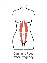 Diastasis in a woman after pregnancy. The anatomy of a Woman. A woman's muscular corset before and after childbirth. Vector illustration
