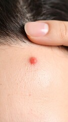 Fototapeta premium Close-up of a pimple on skin with a hand gently touching the area