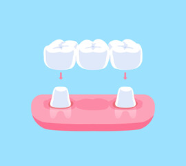 Traditional dental bridges teeth illustration vector design. Dental care concept.