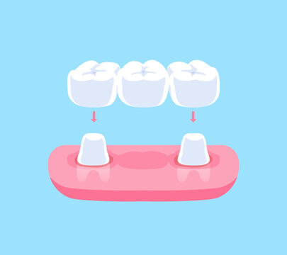 Traditional dental bridges teeth illustration vector design. Dental care concept.