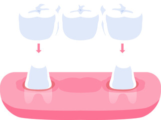 Traditional dental bridges teeth illustration design. Dental care concept.