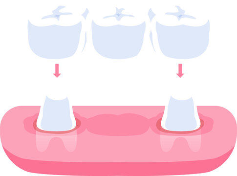 Traditional dental bridges teeth illustration design. Dental care concept.