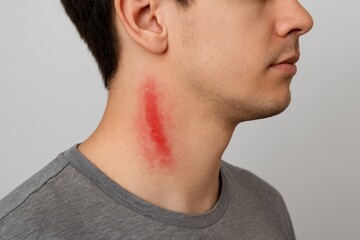 Obraz premium Young man experiencing right neck rash caused by Paederus beetle