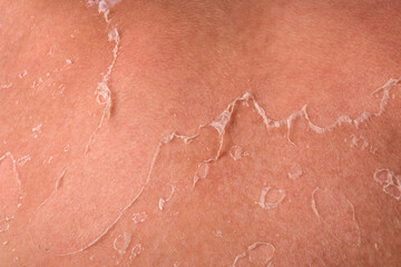 Close-Up of Flaky Peeling Skin on Shoulder Due to Sunburn and UV Exposure