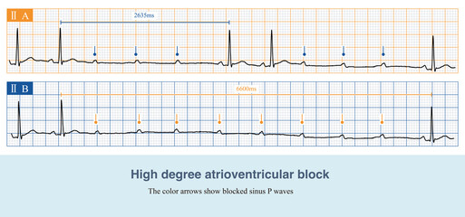 In high degree AV block, more than 2 consecutive P waves fail to descend to the ventricles, including the AV node or subnodal block. Patients are prone to fainting.
