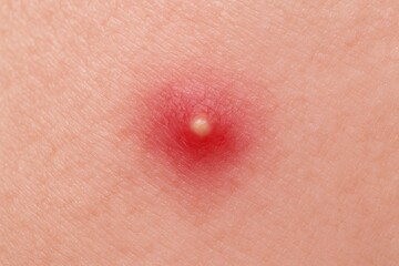 Fototapeta premium Close-up of a red facial pimple showing abscess and acne details