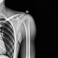 X-ray image showing the shoulder and upper arm bones with clear detail.