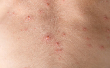 Fototapeta premium Human skin covered with red chickrnpox