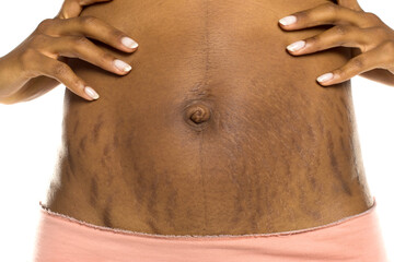 Stretch marks on female stomach after pregnancy with hands touching skin, studio shot on white...
