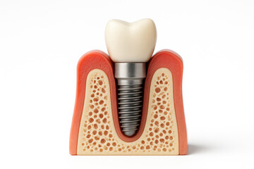 Dental implant model showing artificial tooth structure with titanium screw and gum cross section for oral health education