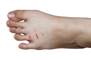 Close-Up of Human Foot with Fresh Red Scratch on Skin Surface