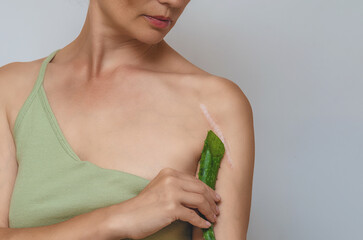 Aloe leaf indicate postoperative scar on shoulder woman. Scar healing, treatment of scars on skin.