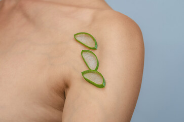 Aloe vera slices on postoperative scar on woman's shoulder. Scar healing, treatment of scars skin.