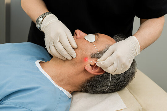 Endolifting procedure on male patient with subdermal laser fiber near cheek area