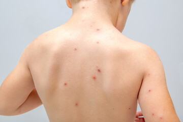Little boy scratching himself,rash on child body,Chickenpox,Varicella contagion virus,...