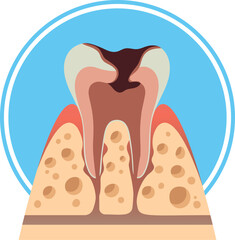 Caries at tooth destruction stage