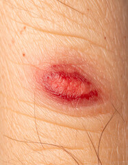 Fototapeta premium A close-up of abstract, textured skin around a blurred wound showing stylized redness, indicating localized inflammation.