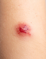 A close-up of abstract, textured skin around a blurred wound showing stylized redness, indicating localized inflammation.