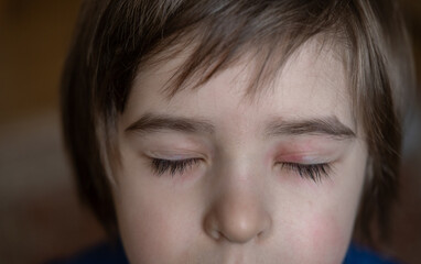 Stye or sty on the boy eye. The eye is swollen. The eyelid is red and inflamed