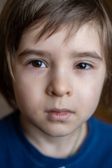 Stye or sty on the boy eye. The eye is swollen. The eyelid is red and inflamed